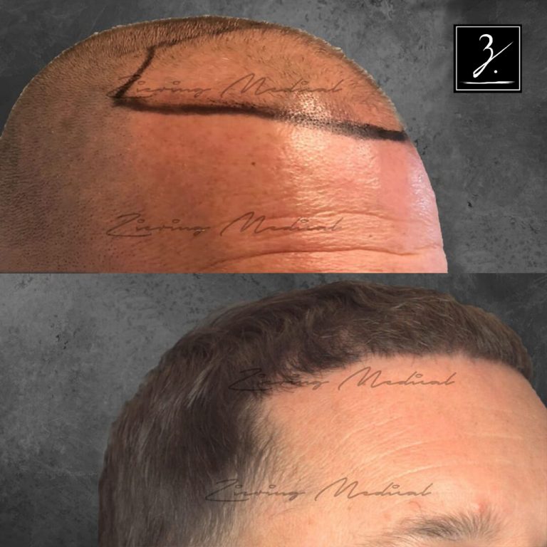 Male Hair Transplant Before And After Photos Ziering Medical