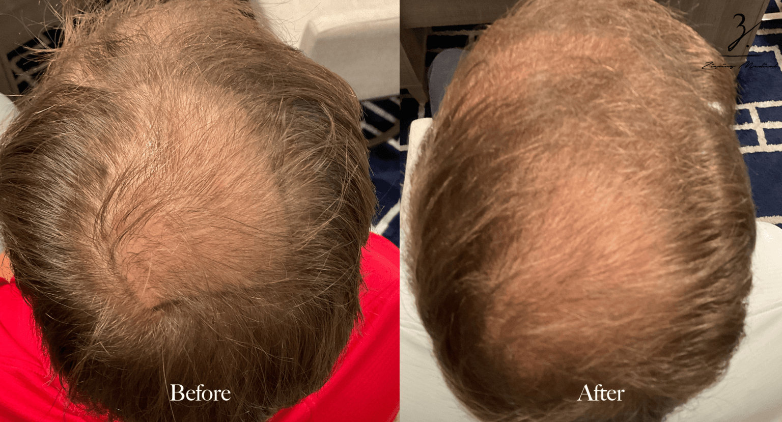 Ziering Whorl Hair Transplant Result Before And After Ziering Medical