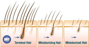 About Hair Loss Pic2 | Ziering Medical | West Hollywood CA, Newport Beach CA, New York NY, Greenwich CT, Las Vegas NV