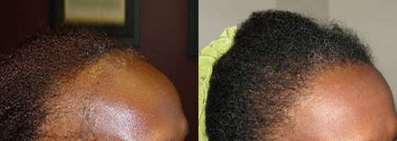 Before & After Female Hair Transplant