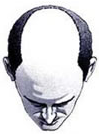 Hair Baldness Pic 4 | Ziering Medical | West Hollywood CA, Newport Beach CA, New York NY, Greenwich CT, Las Vegas NV