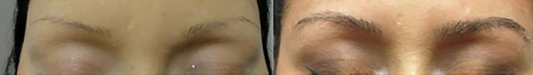 Before & After Eyebrow Transplant | Ziering Medical | West Hollywood CA, Newport Beach CA, New York NY, Greenwich CT, Las Vegas NV