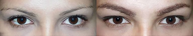 Eyebrow Results Before & After | Ziering Medical | West Hollywood CA, Newport Beach CA, New York NY, Greenwich CT, Las Vegas NV