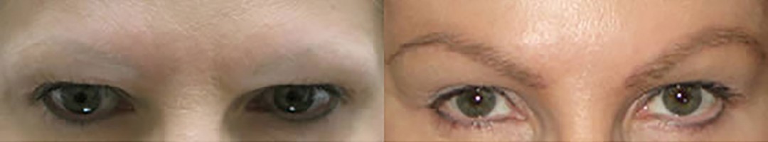 Before & After Eyebrow Transplant | Ziering Medical | West Hollywood CA, Newport Beach CA, New York NY, Greenwich CT, Las Vegas NV