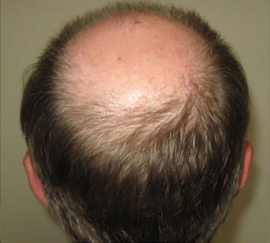 Male Hair Transplant Before and After Photos Ziering Medical