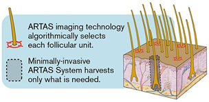 Artas target technology illustration | Ziering Medical