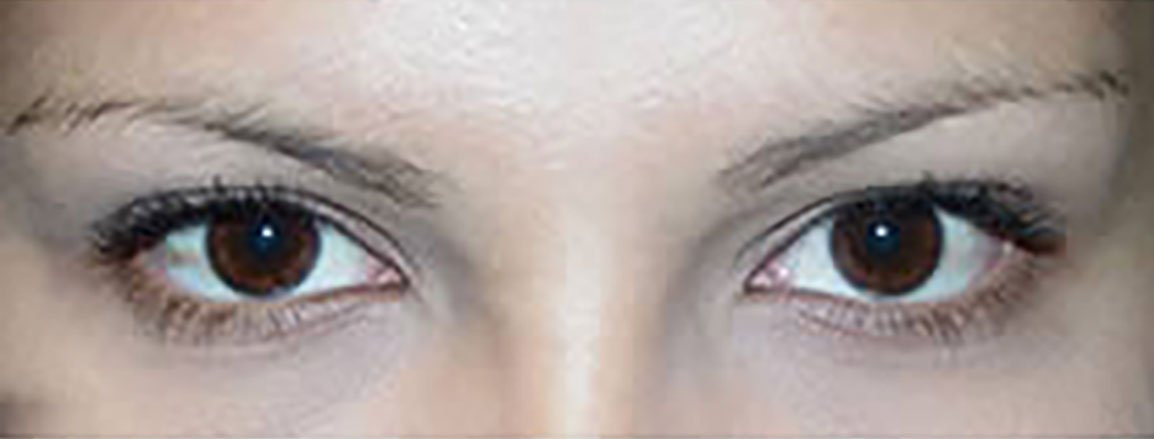 Before Eyebrow Transplant | Ziering Medical | West Hollywood CA, Newport Beach CA, New York NY, Greenwich CT, Las Vegas NV