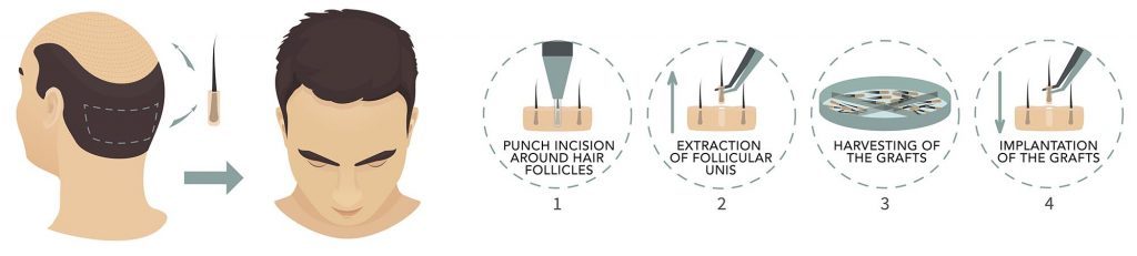 FUE Hair Transplantation Steps