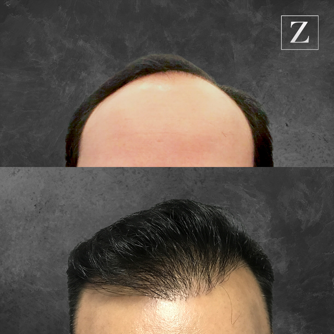 Before and After Male Robotic Hair Transplant Patient 2 | Ziering Medical | West Hollywood CA