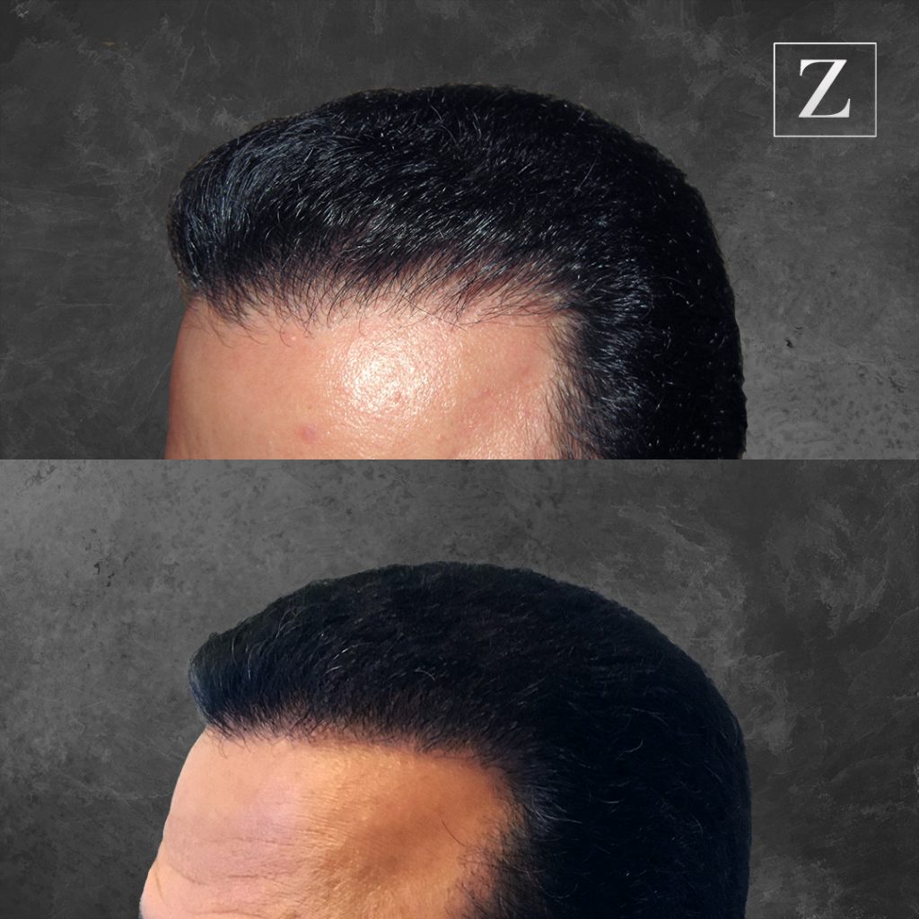 Before and After Male Hair Transplant | Ziering Medical | West Hollywood CA, Newport Beach CA, New York NY, Greenwich CT, Las Vegas NV