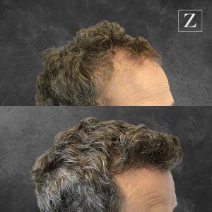 before and after male hair transplant | Ziering Medical | West Hollywood CA, Newport Beach CA, New York NY, Greenwich CT, Las Vegas NV
