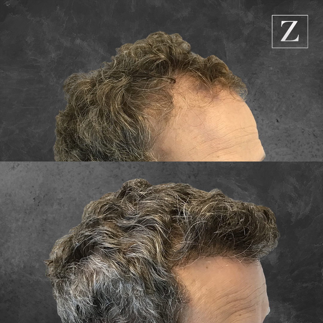 before and after male hair transplant | Ziering Medical | West Hollywood CA, Newport Beach CA, New York NY, Greenwich CT, Las Vegas NV