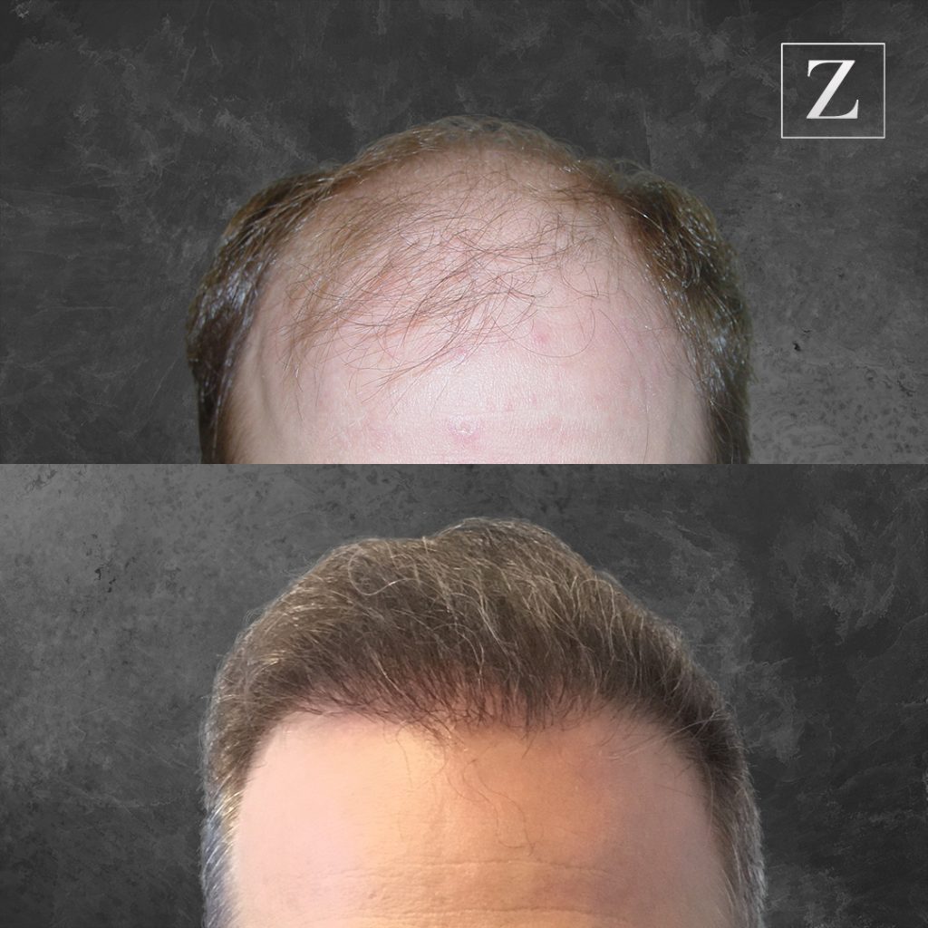 Before and After Male Hair Transplant | Ziering Medical | West Hollywood CA, Newport Beach CA, New York NY, Greenwich CT, Las Vegas NV