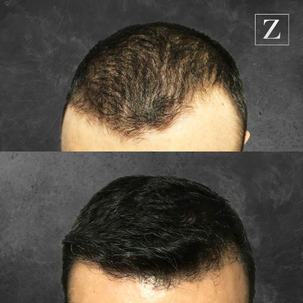 Before and After Male Robotic Hair Transplant Patient 1