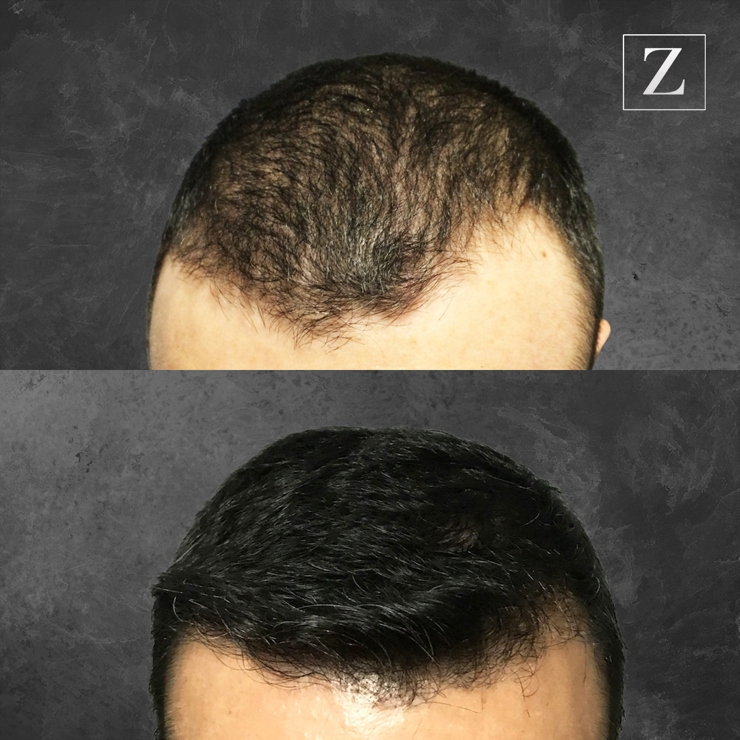 Пересадка волос тюмень. DHI трансплантация волос. Man hair transplant before after.