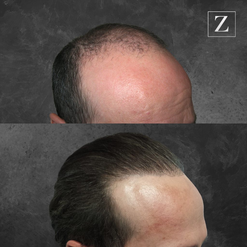 The Steps To Fue Hair Transplant Surgery Ziering Medical 