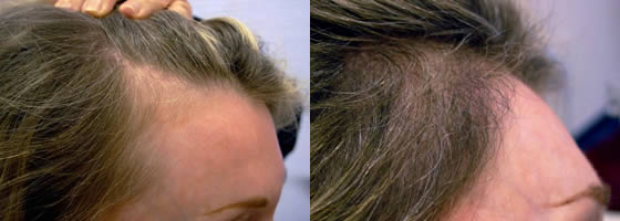 hair transplant women