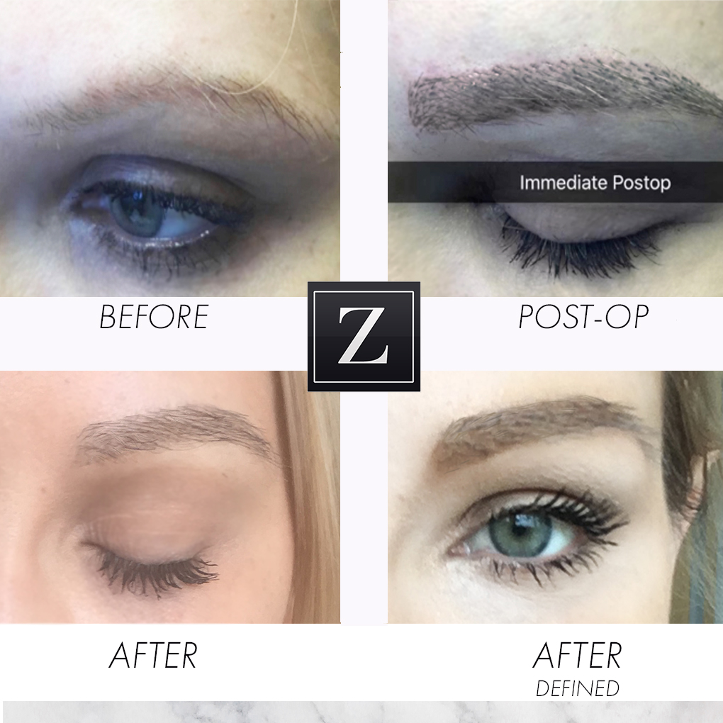Eyebrow Treatment Before and After | Ziering Medical | West Hollywood CA, Newport Beach CA, New York NY, Greenwich CT, Las Vegas NV
