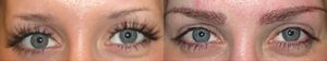 Eyebrow Hair Restoration Surgery Results Before and After Patient 1 | Ziering Medical | West Hollywood CA, Newport Beach CA, New York NY, Greenwich CT, Las Vegas NV