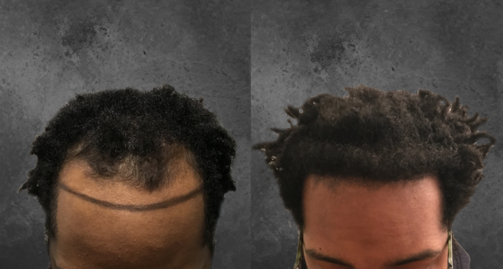 African American Hair Transplant | Ziering Medical | Get Appointment Now!