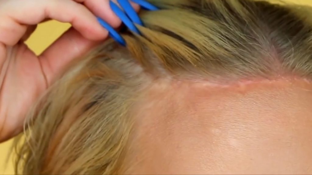 Transgender Hair Loss Treatments