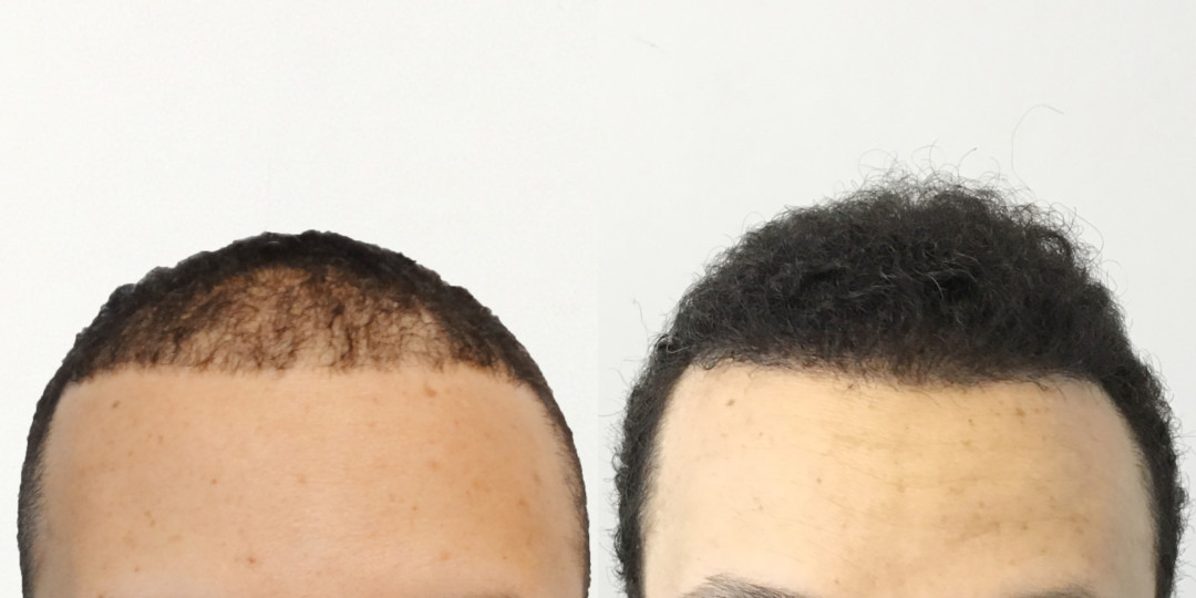 Hair Restoration Results Before and After | Ziering Medical | West Hollywood CA, Newport Beach CA, New York NY, Greenwich CT, Las Vegas NV