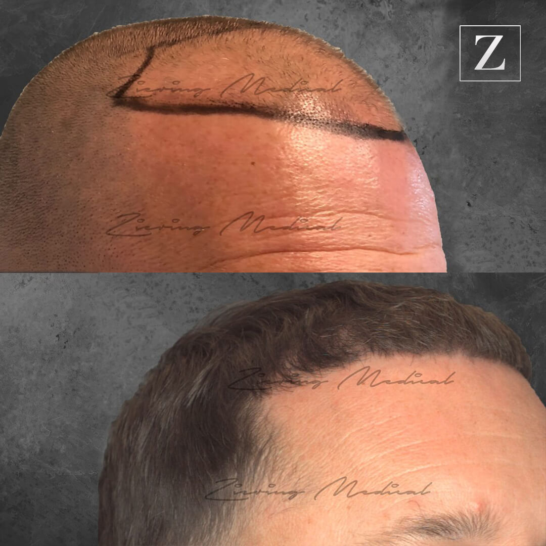 Male Hair Transplant Before & After | Ziering Medical | Hair Treatment for Men | West Hollywood CA, Newport Beach CA, New York NY, Greenwich CT, Las Vegas NV