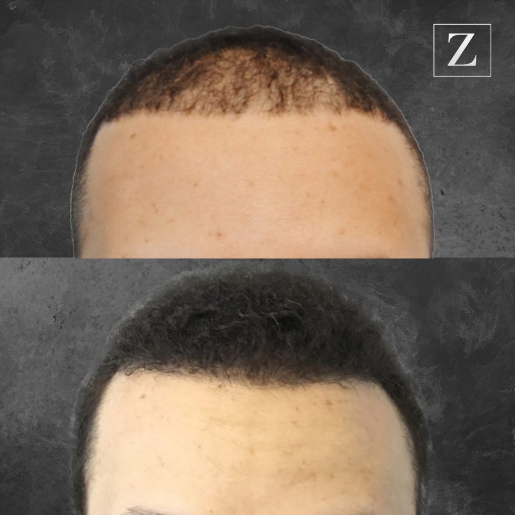 Male Hair Transplant Before & After | Ziering Medical | Hair Restoration | West Hollywood CA, Newport Beach CA, New York NY, Greenwich CT, Las Vegas NV