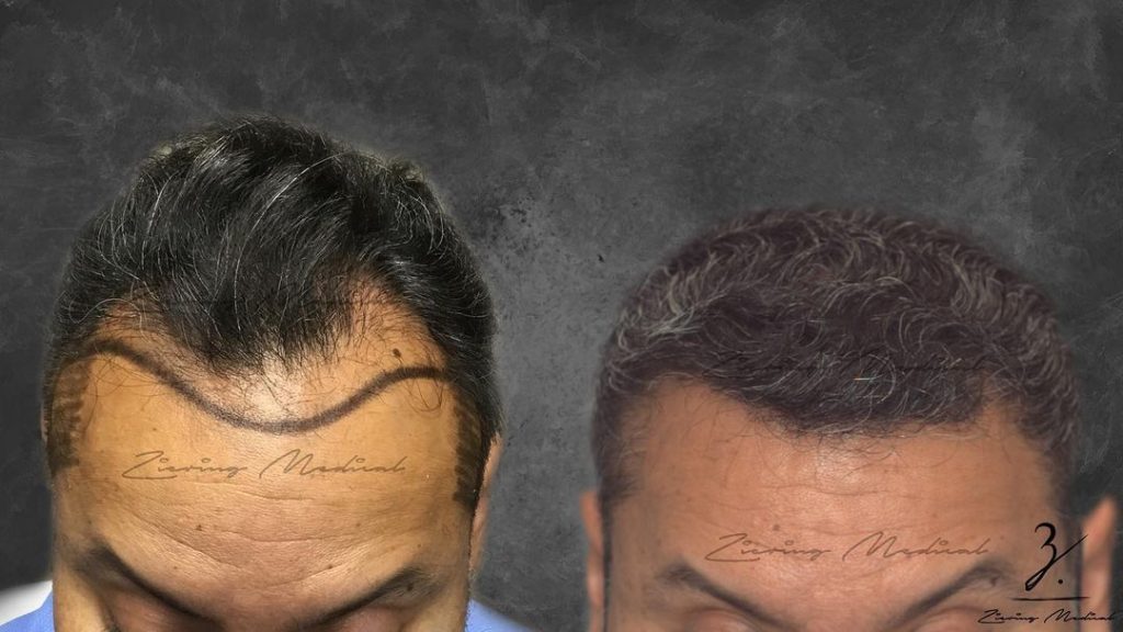 hair transplants Male Patient before and after | Ziering Medical | follicular unit extraction FUE | West Hollywood CA, Newport Beach CA, New York NY, Greenwich CT, Las Vegas NV