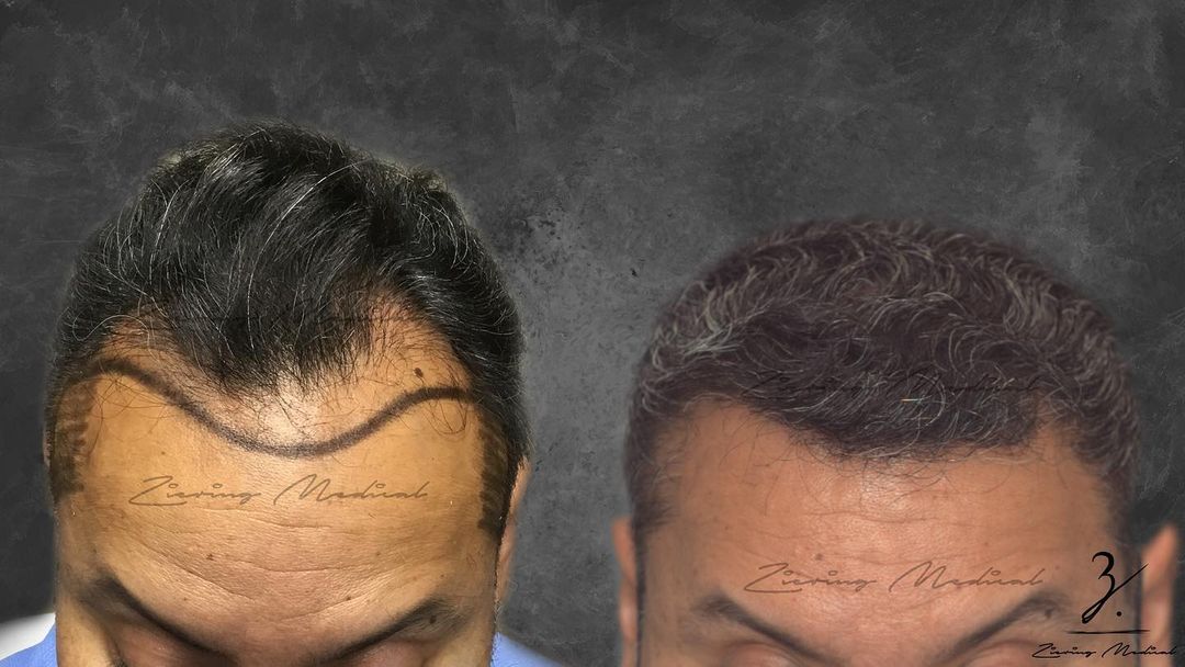 hair transplant men