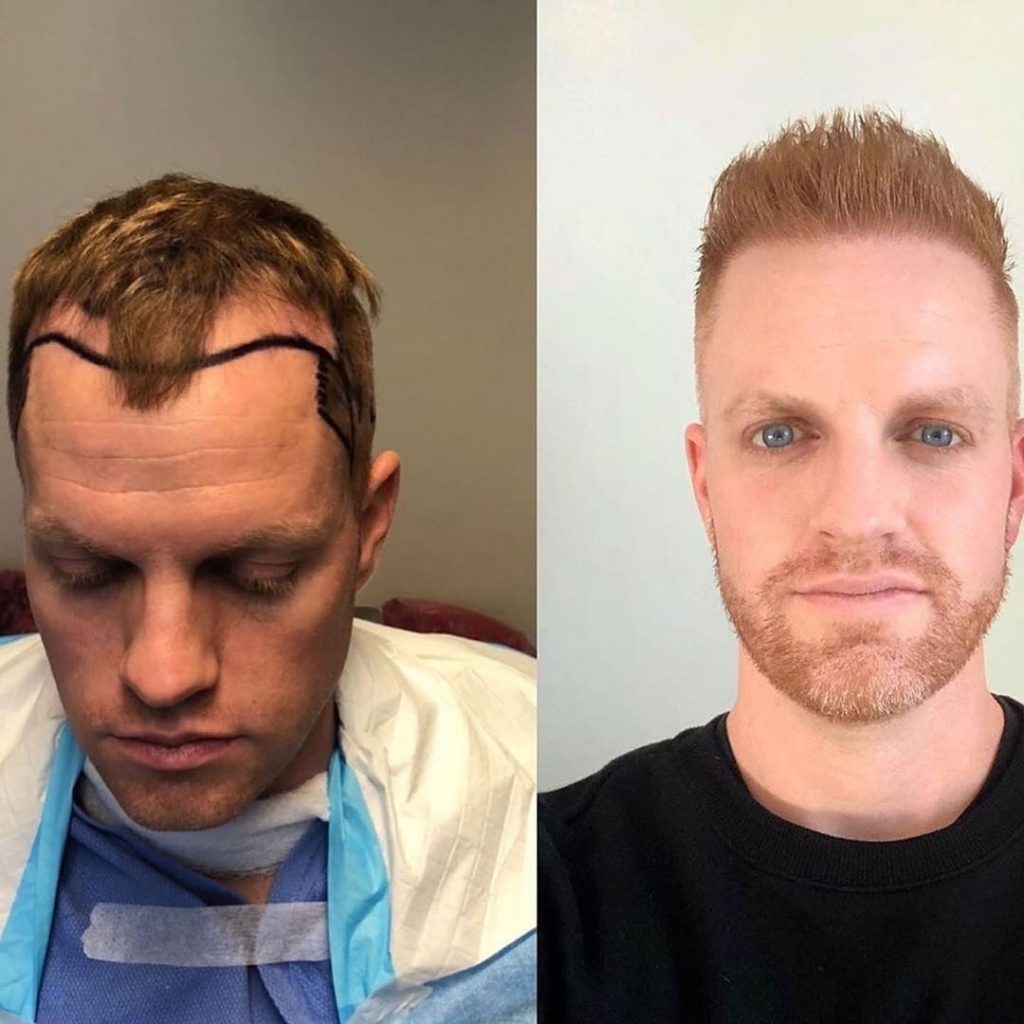 FUE Male Patient before and after Hair Transplant | Ziering Medical | Follicular Unit Extraction | West Hollywood CA, Newport Beach CA, New York NY, Greenwich CT, Las Vegas NV