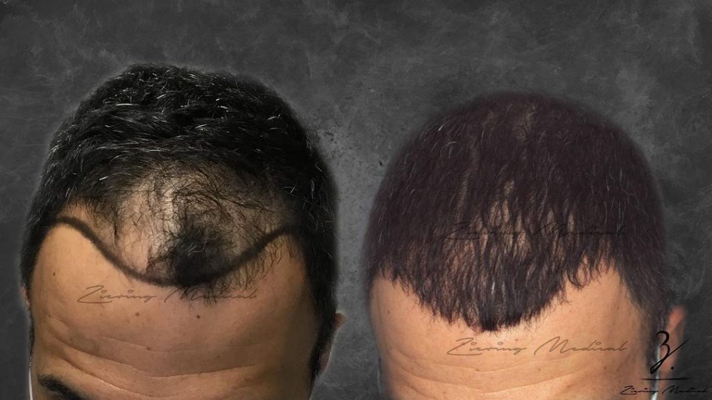 hair transplants Male Patient before and after | Ziering Medical | follicular unit extraction FUE | West Hollywood CA, Newport Beach CA, New York NY, Greenwich CT, Las Vegas NV