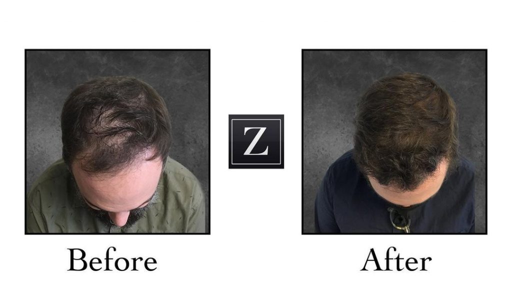 Male Hair Transplant Before and After Photos Ziering Medical