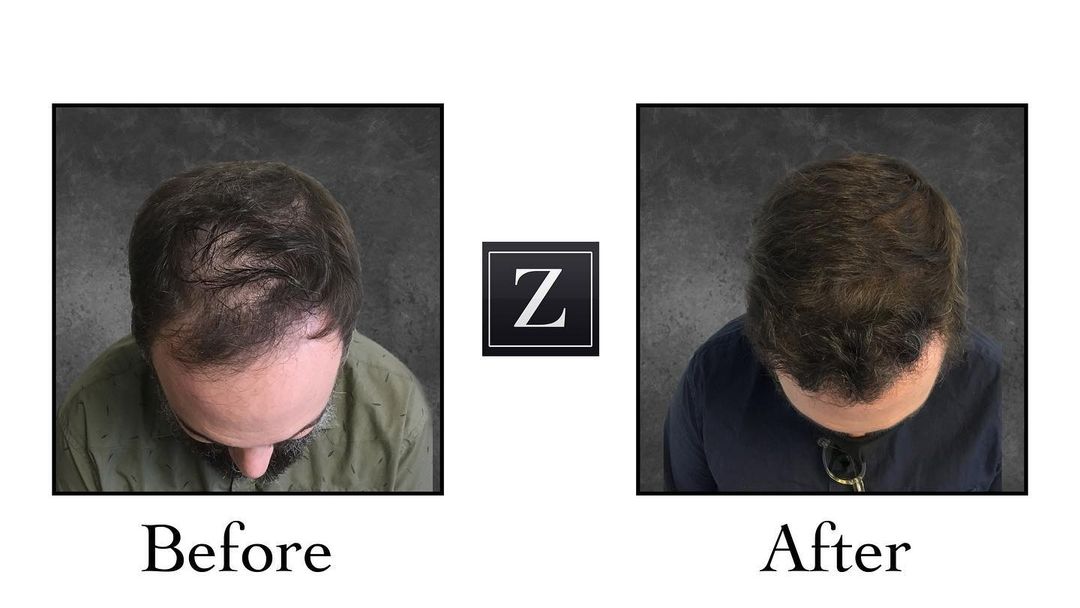 Male Patient before and after Hair Restoration | Ziering Medical | FUE Hair Transplant | West Hollywood CA, Newport Beach CA, New York NY, Greenwich CT, Las Vegas NV