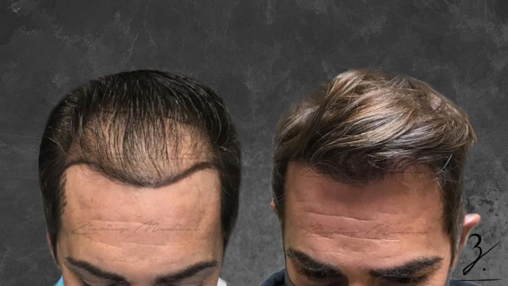 follicular unit extraction hair transplants Male Patient before and after | Ziering Medical | Microscopically Dissected Elliptical Excision (MDEE) | West Hollywood CA, Newport Beach CA, New York NY, Greenwich CT, Las Vegas NV
