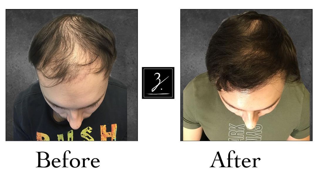 Male Patient before and after Hair Restoration | Ziering Medical | FUE Hair Transplant | West Hollywood CA, Newport Beach CA, New York NY, Greenwich CT, Las Vegas NV