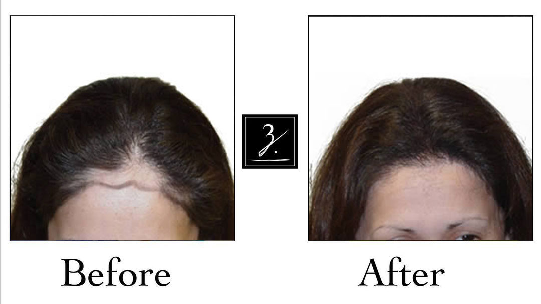 1500 Follicular Units, 1 Hair Transplant, Showing Pre-Op Photos and 5 Months Post-Op.