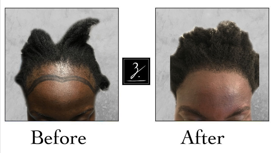 2500 Follicular Units, 1 MDEE (Formerly Known as FUT) Hair Transplant Procedure, Showing Pre-Op and 17 Months Post-Op