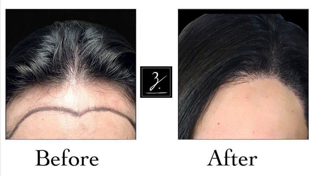 2662-Follicular-Units,-1-MDEE-Hair-Transplant-Procedure-for-Hairline-Lowering,-Showing-Pre-Op-and-24-Months-Post-Op.