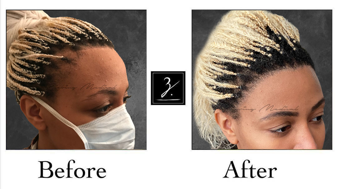 hair transplant women