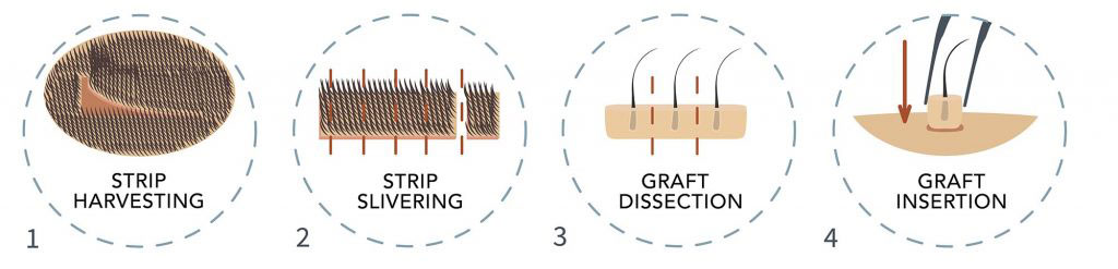 FUT Hair Transplant Diagram - Ziering-Medical