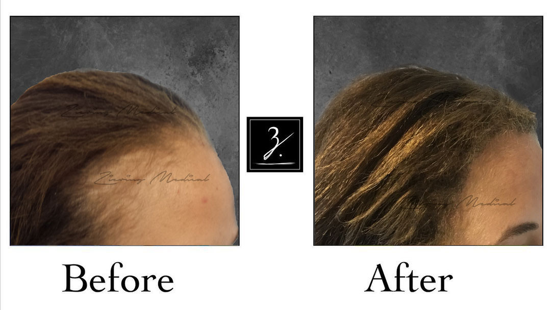 Female Hair Transplant Land | Ziering Medical | Get Appointment Now!