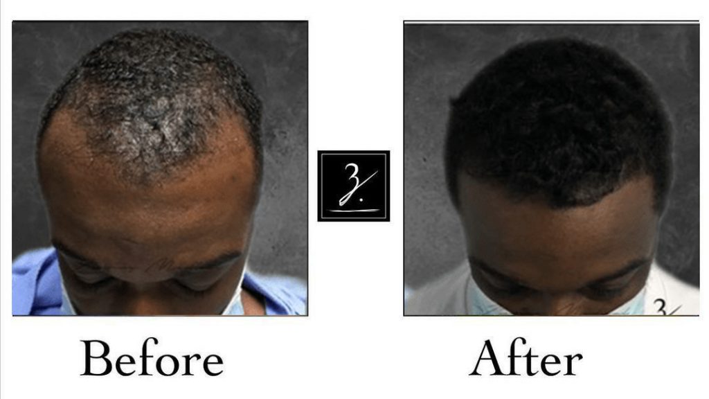 Hair Transplants for Women Before and After Photos - Foundation For Hair  Restoration