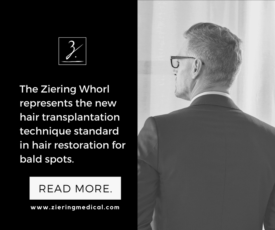 Are Hair Whorls Bald Spots? | Ziering Medical
