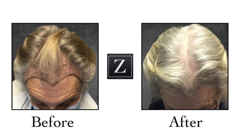2700-Follicular-Units-1-MDEE-formerly-known-as-FUT-Procedure-Showing-Pre-Op-and-6-Months-Post-Op-Z-Factors
