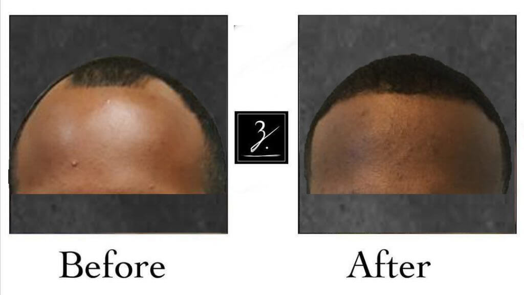Hair Transplant Results Before and After | HLC Hairline Clinic