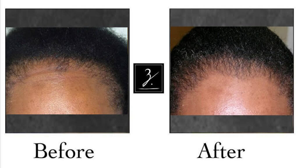 African American Hair Transplant Photos | Ziering Medical