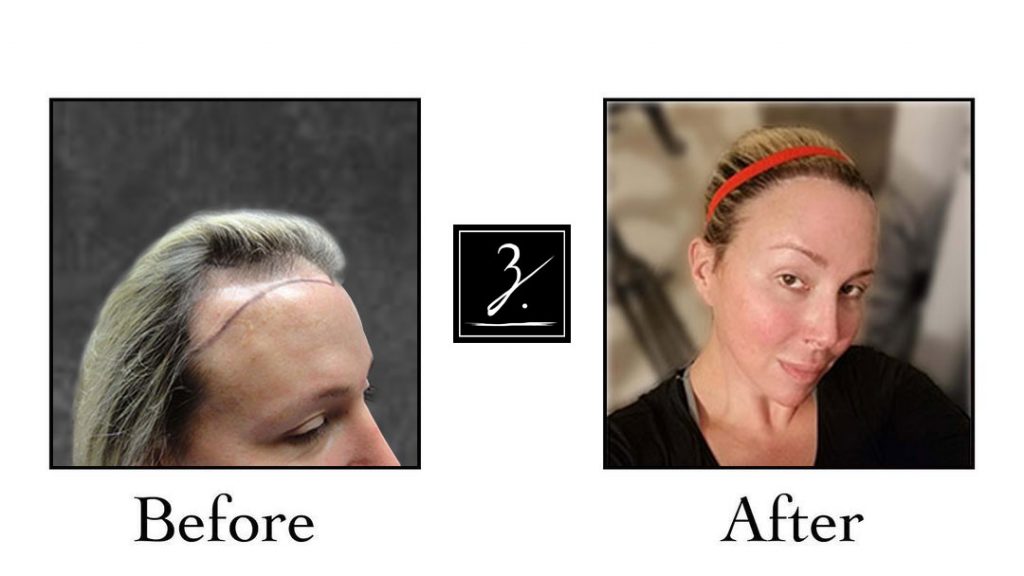 Transgender Hair Transplant, Before and After Photos