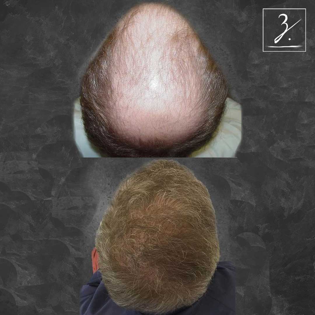 zieringmedical 2 Follicular Unit Strip Surgery with 4250 total grafts