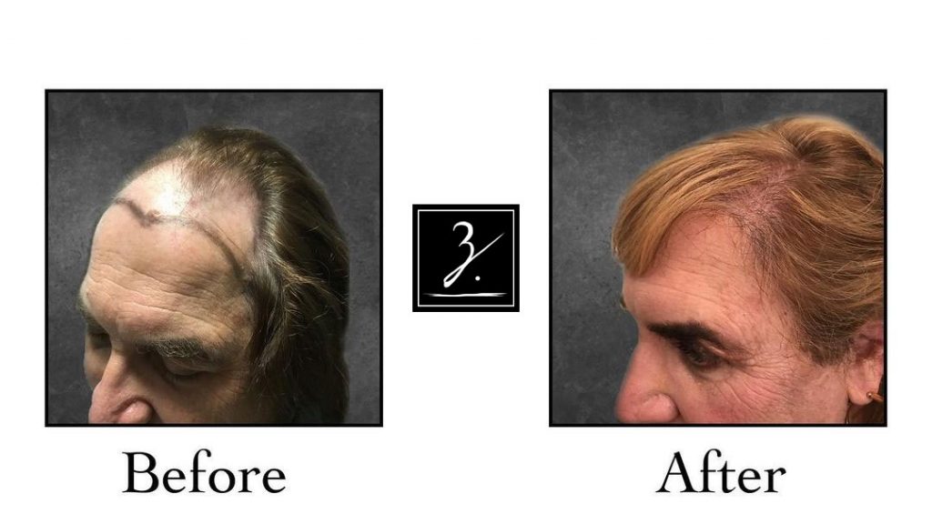 Transgender Hair Transplant Before and After Photos - Foundation For Hair  Restoration